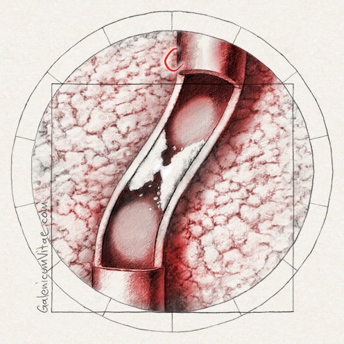 Prevenir infartos de miocardio y sus causas