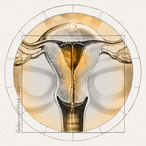 El dispositivo intrauterino (DIU) y sus causas