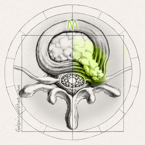 Discos vertebrales y sus causas