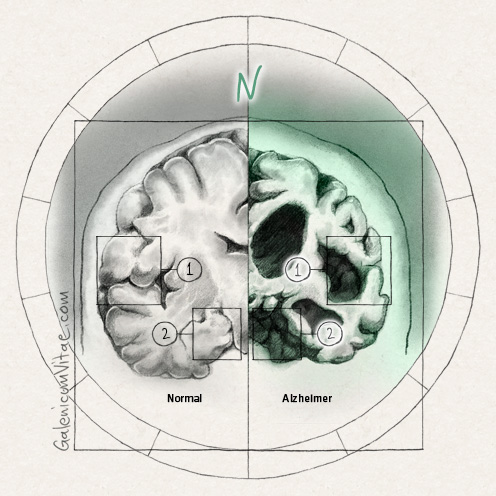 Cambios en el cerebro y sus causas