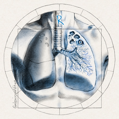 Tuberculosis pulmonar y sus causas